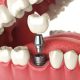Trồng răng Implant giá bao nhiêu 2022?
